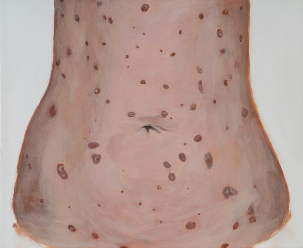 Cecily Brennan, Woman with Koebnersing Psoriasis, 2003, egg tempera on gesso, 25.5 x 30.75 cm. Purchased, 2004. © the artist_